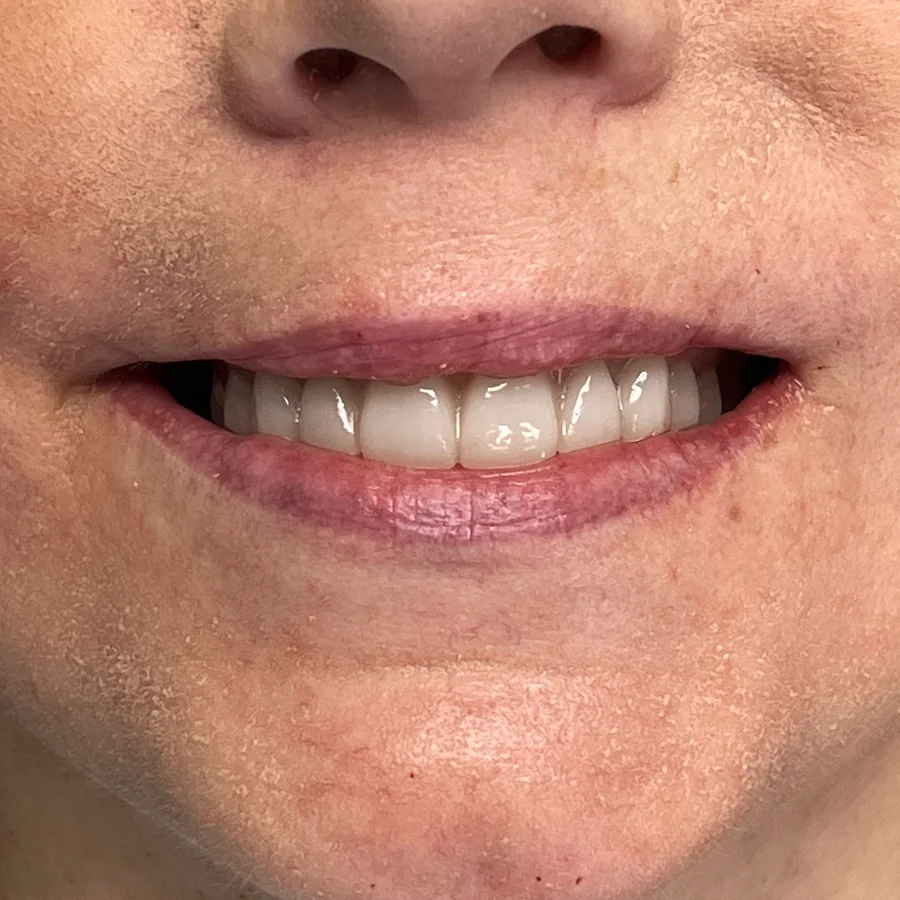 All-on-X case 1, upper arch: fixed temporary teeth on surgery day