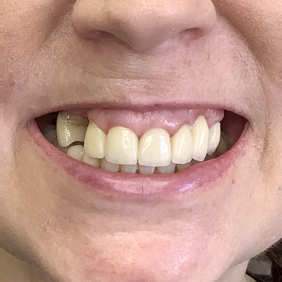 All-on-X case 1, upper arch: the smile before treatment