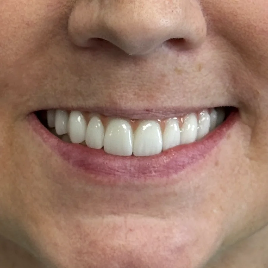 All-on-X case 1, upper arch: the final teeth after healing