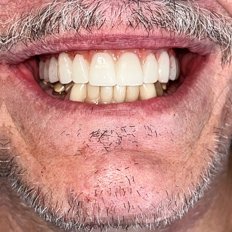 All-on-X case 2, upper arch: fixed temporary teeth on surgery day