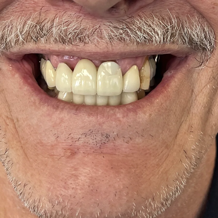 All-on-X case 2, upper arch: the smile before treatment