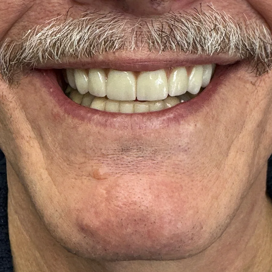 All-on-X case 2, upper arch: the final teeth after healing