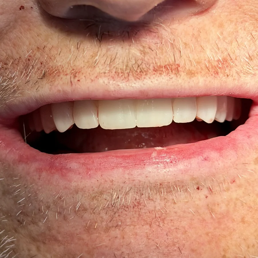 All-on-X case 3, upper and lower arches: fixed temporary teeth on surgery day