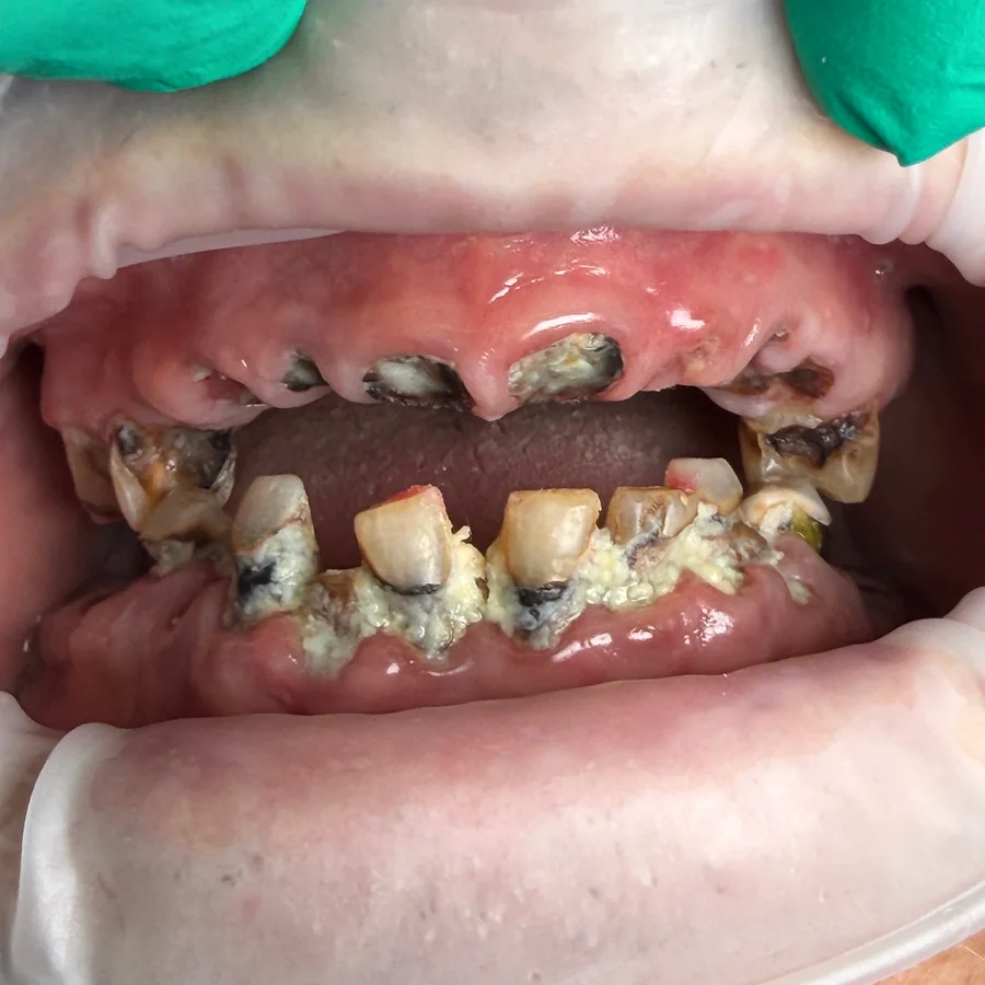 All-on-X case 3, upper and lower arches: the smile before treatment