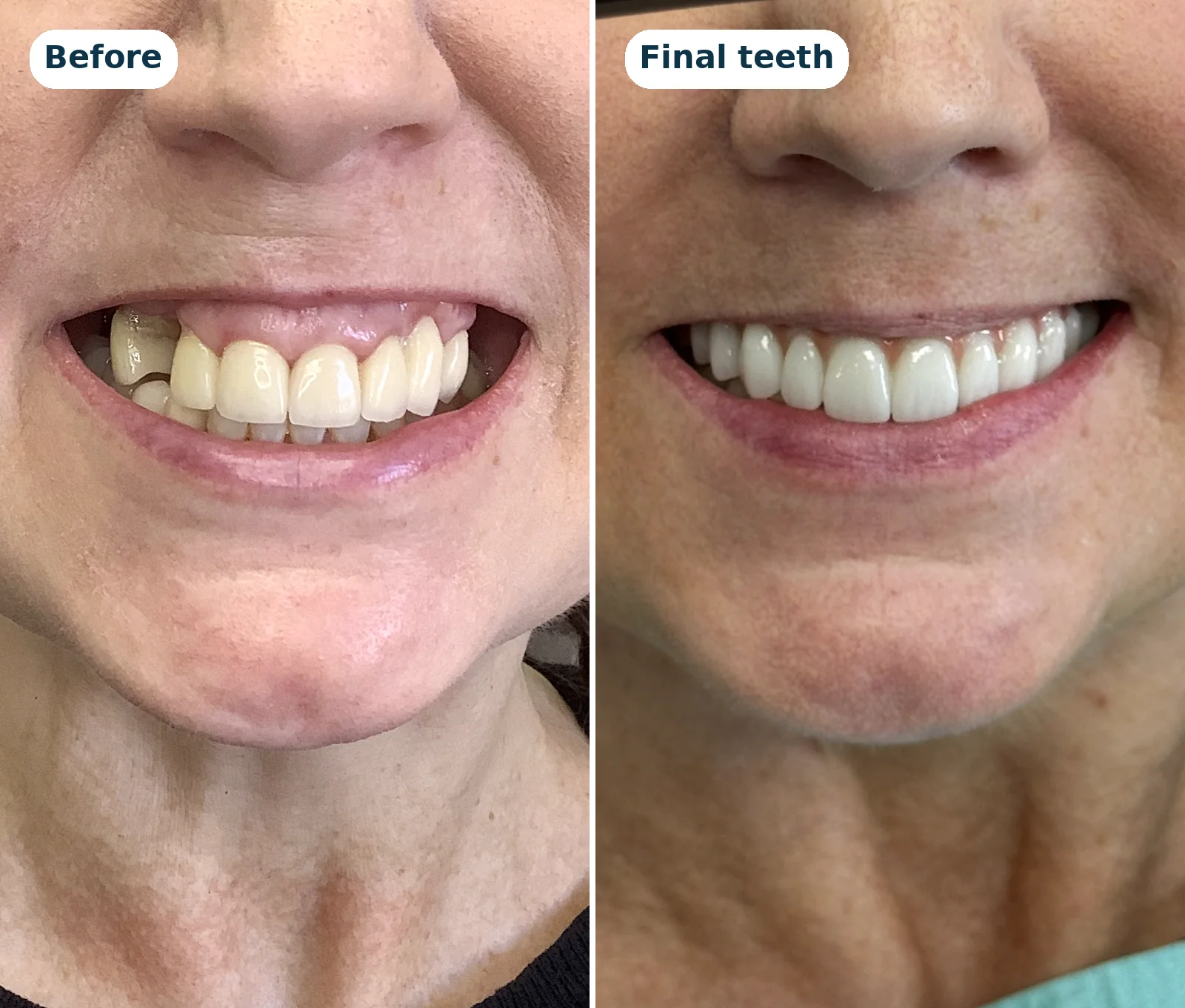 Before and after: an upper All-on-X patient's smile, and the same smile with fixed temporary teeth on surgery day