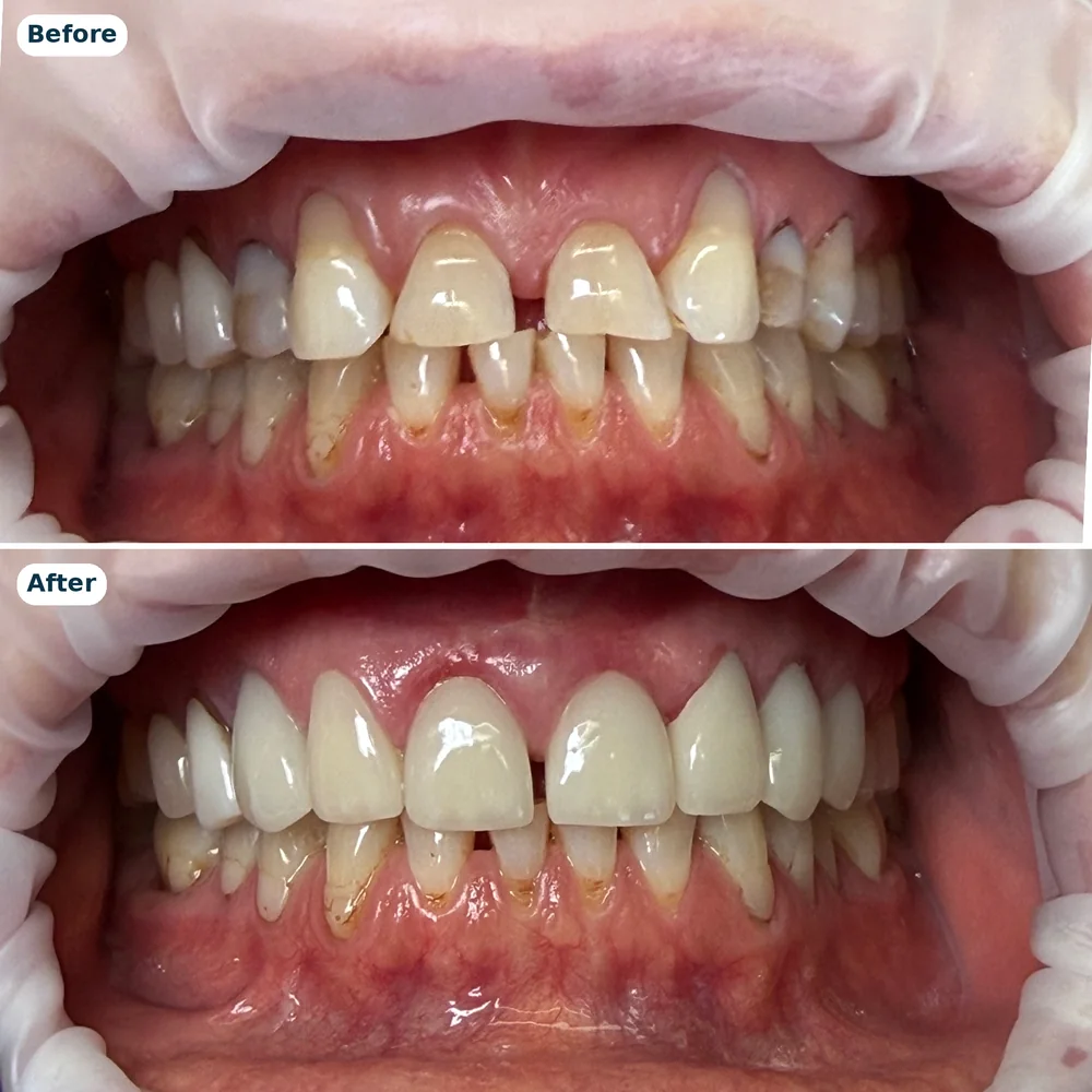 Upper veneers case 1: before (top) and after (bottom)