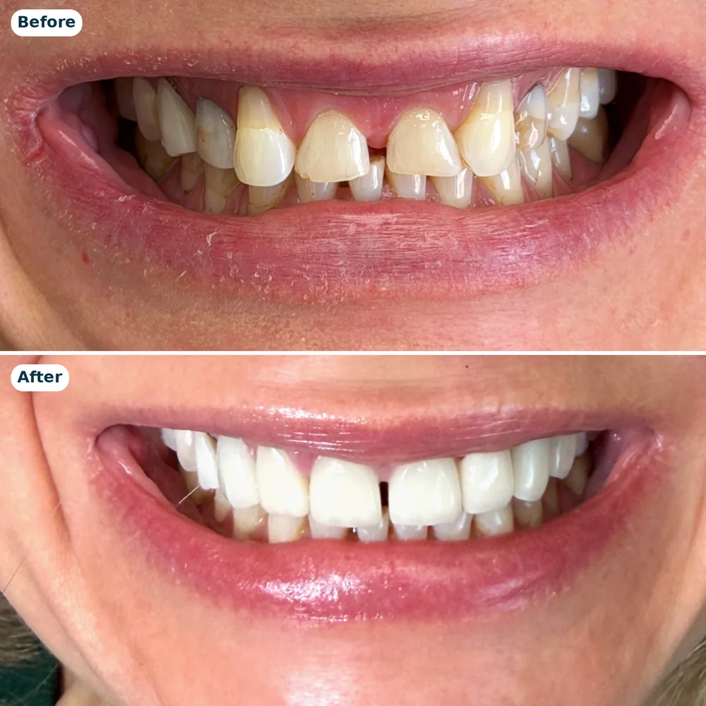 Upper veneers case 2: before (top) and after (bottom)