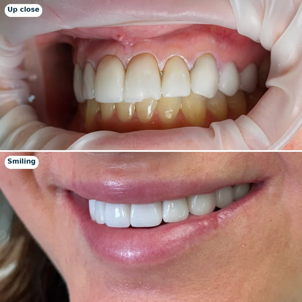 Upper veneers case 3: close-up (top) and smiling (bottom)